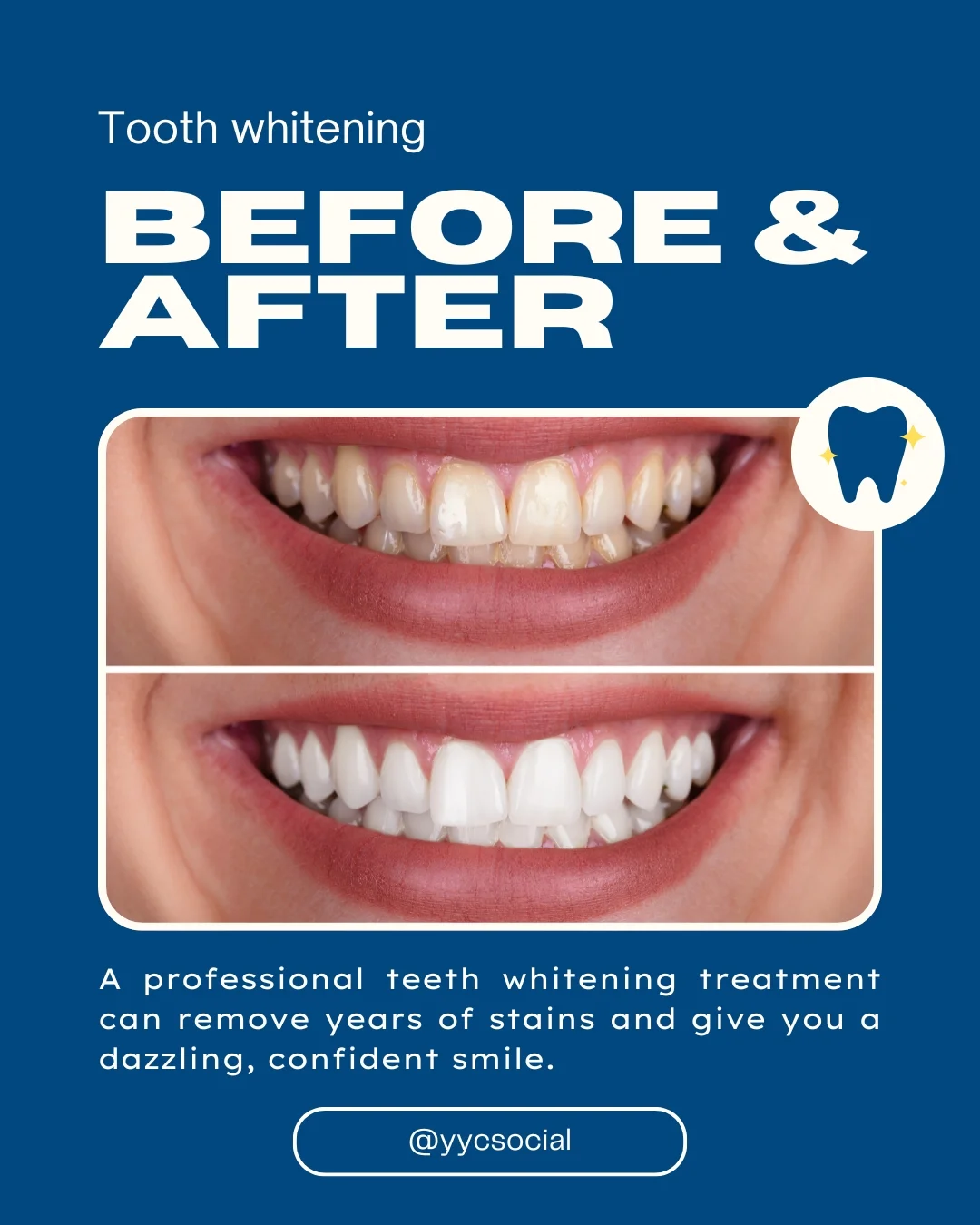Social media post for teeth whitening